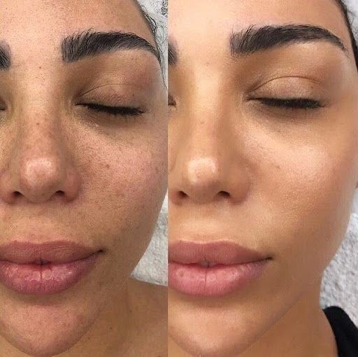RED ONE ClearDome Skin System