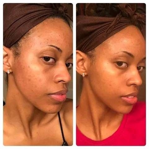 RED ONE ClearDome Skin System